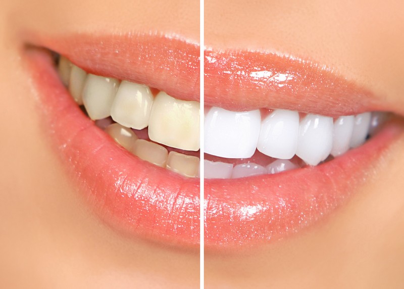 Teeth Whitening  Oceanside, CA 